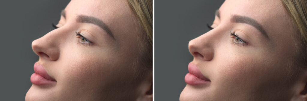 Crooked nose surgery to improve nasal alignment, shape, and facial balance.