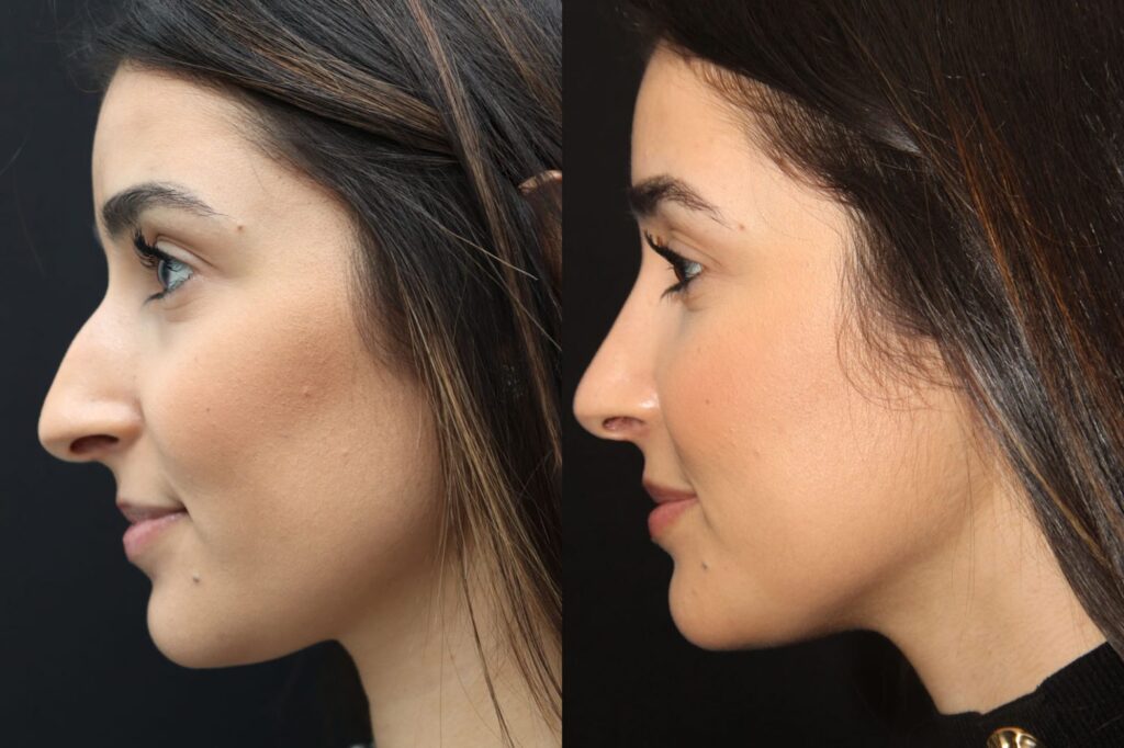 Female Rhinoplasty consultation for refining nose shape and improving facial balance