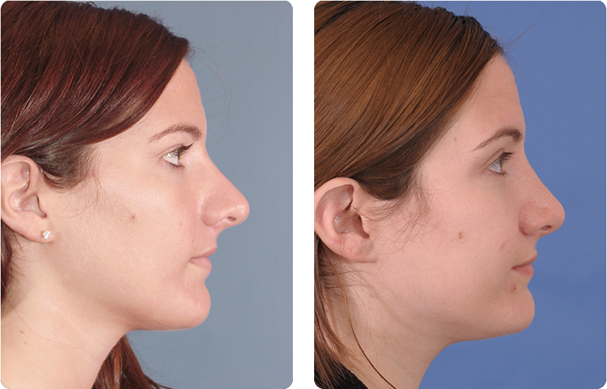 Before-and-after rhinoplasty results showing changes in the nose shape and facial appearance.