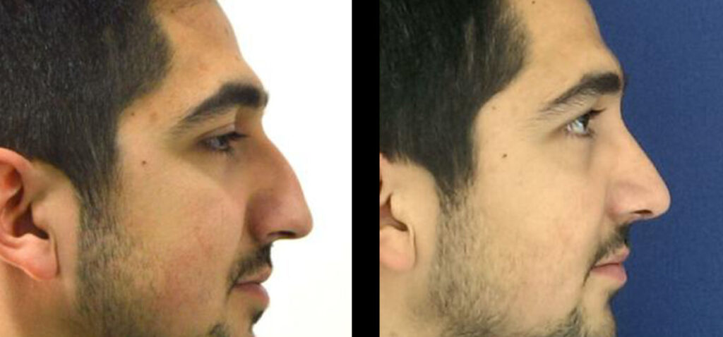 Male Rhinoplasty: Refine Your Look With Nose Reshaping