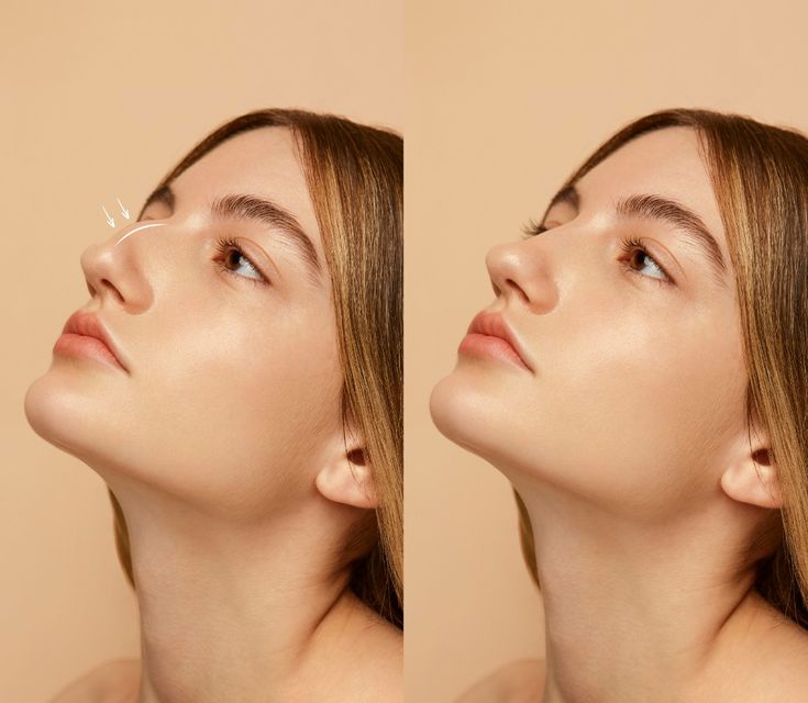 Revision rhinoplasty showing nasal structure and changes after previous nose surgery