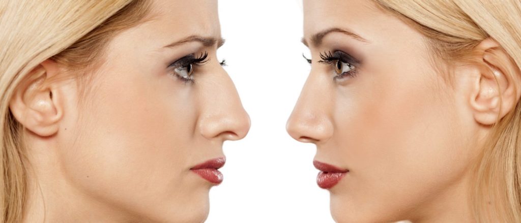 Rhinoplasty and septoplasty consultation for improving nasal shape and breathing function