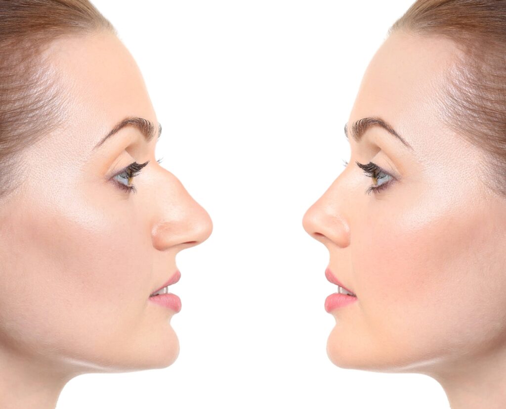 Rhinoplasty surgery to improve nose symmetry and create a balanced facial appearance.