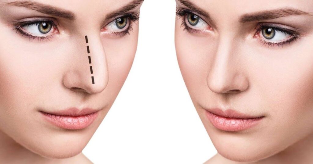 Natural-looking nose reshaping surgery results with balanced facial proportions.